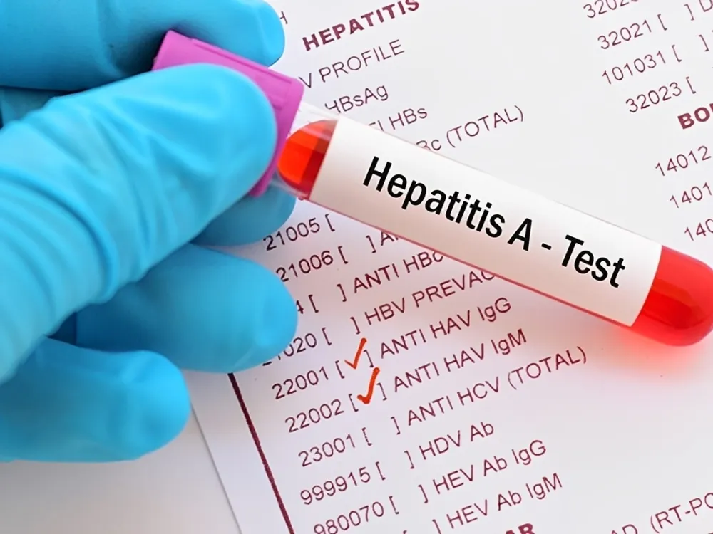 Hepatitis A: Se confirmaron 32 casos nuevos y el país entró en zona de alerta sanitaria